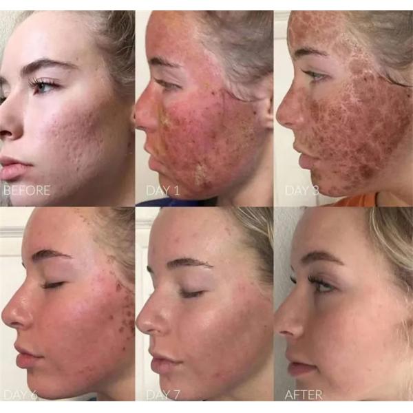 Настольный частичный затягивать кожи тела удаления шрама машины лазера