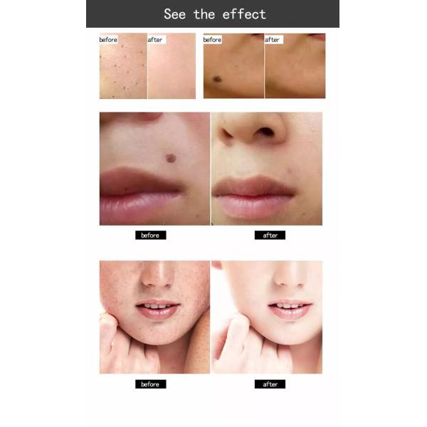 Korea Beauty Plasma 2 In1 Pen Spot Mole Removal 2 In 1 Plasma Pen For Beauty Salon Use