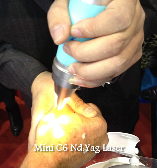nd yag laser remove tattoo/nd yag laser freckles removal/q switched nd yag laser
