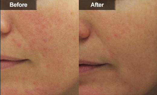 Удаление Varicose вен лазера диода лазера 980nm диода удаления кровеносных сосудов