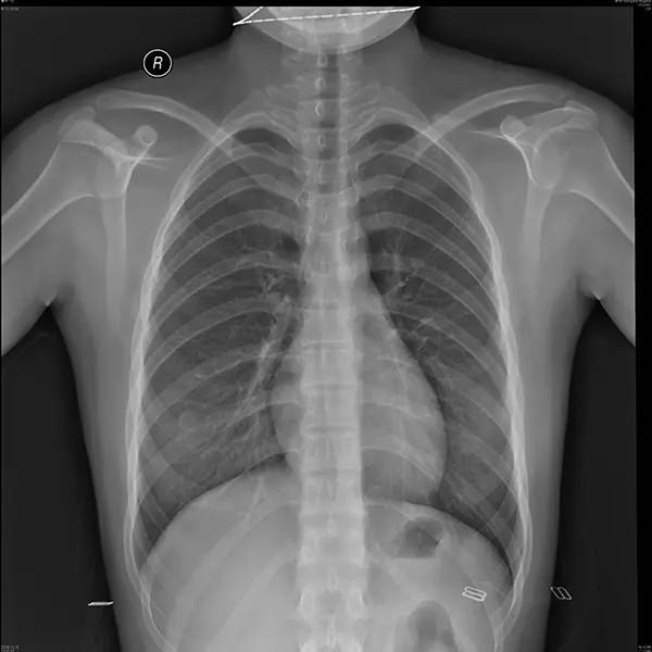 Blue Laser X Ray Film For Single Use With Superior Print Quality