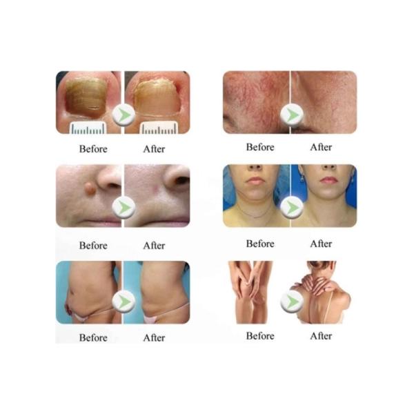 Не-хирургический самый лучший лазер обработки лицевой Endolifting1470nm Endolift стороны и стороны лазера подтяжки лица тела поднимаясь