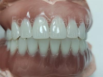 Comfortable Full Upper Acrylic Denture Complete Acrylic Denture With Ivoclar Teeth