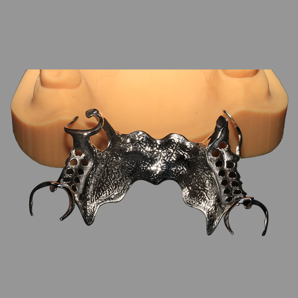 3D Printed CoCr Metal Framework Partial Nickel Free Lightweight