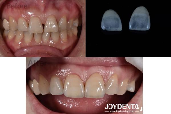 0.5mm épaisseur faisceaux dentaires Perméabilité parfaite Faisceaux de porcelaine pour les dents creuses