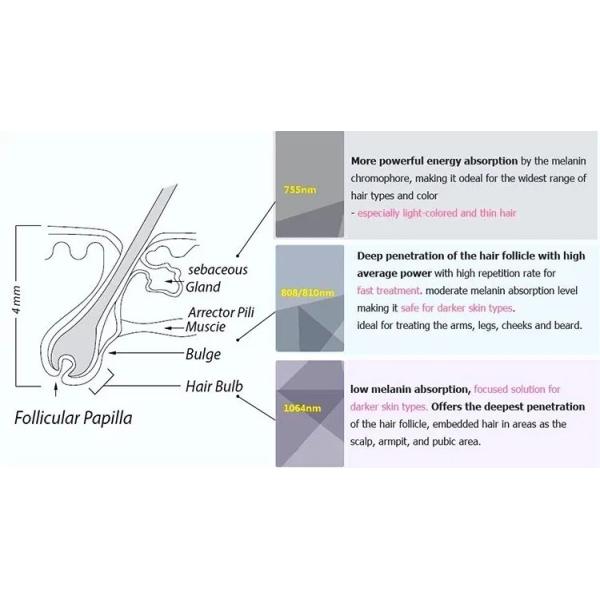 депиляция лазера экрана 1800W Yag платины льда сопрано машины удаления волос диода 808nm большая