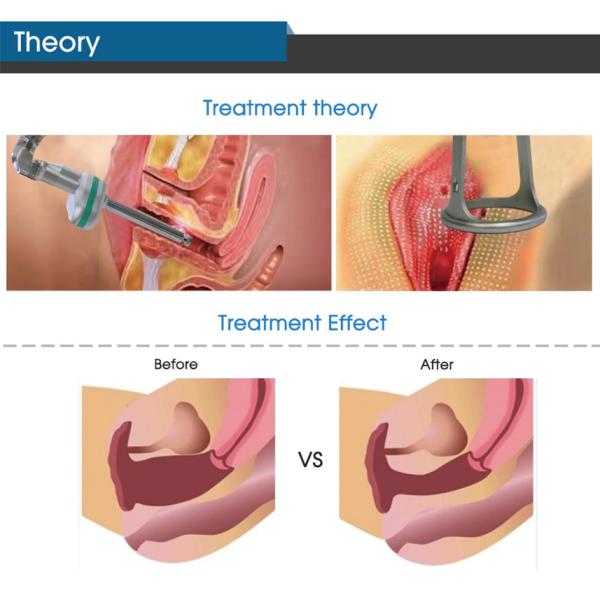 Dispositivo fraccionario del laser del CO2 médico para la piel del retiro de la cicatriz que vuelve a allanar el ajuste
