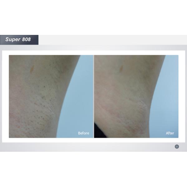 волна машины удаления волос лазера диода 755nm 808nm 1064nm тройная