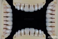 Céramique pour l'esthétique naturelle Faisceaux dentaires Résistance aux taches Maintient la luminosité Une forte liaison avec l'émail des dents pour un ajustement sûr