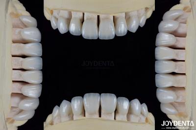 Ceramic For Natural Aesthetics Dental Veneers Stain Resistance Maintains Brightness Strong Bond With Tooth Enamel For Secure Fit