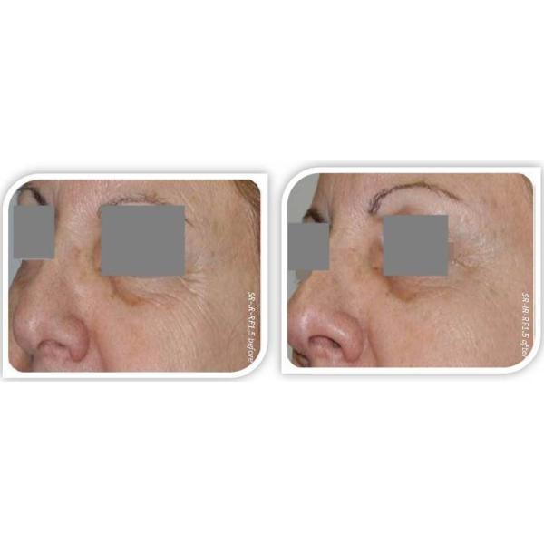 RF bodying slimming equipment