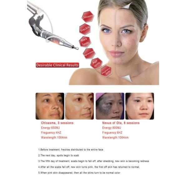 Nd Yag Laser Tattoo Removal Machine