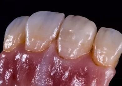 German Amanjilbach Zirconia Dental Crown High Density With Customization