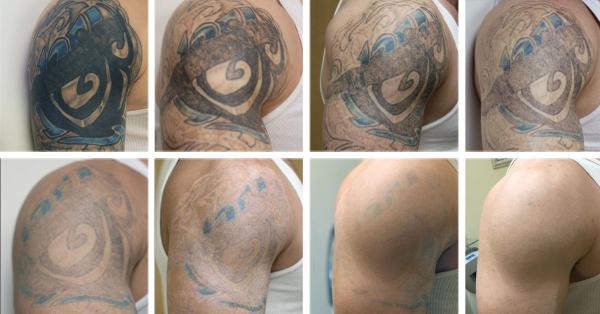 Minimal Recovery Q Switch ND Yag Laser System For Hyperpigmentation / Birthmark Removal