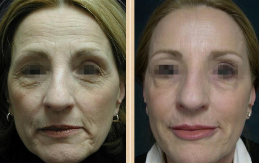 Hyaluronic кисловочный заполнитель ультра 4 вводимый дермальный 2x1 ML Juvederm