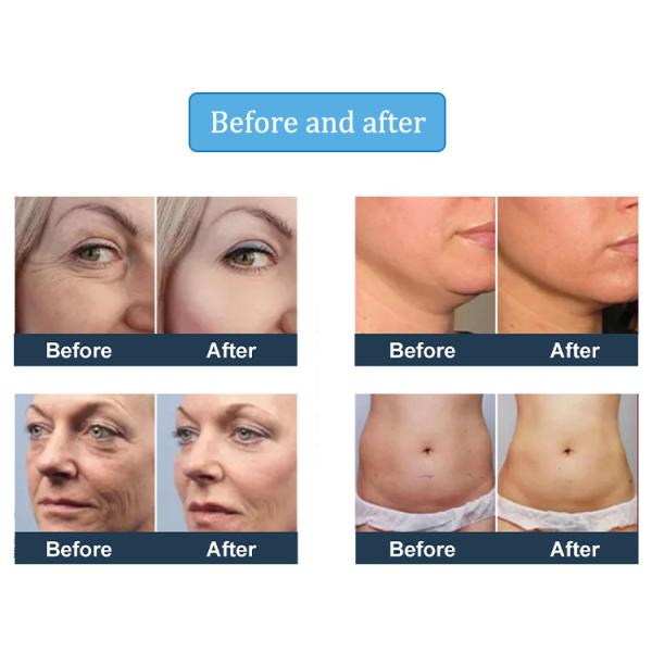 5 In 1 Smas Face And Neck Lift HIFU High Intensity Focused Ultrasound Machine