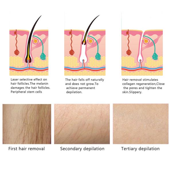 808 - 810 nm Diode Laser Removal Hair Machine With Non Channel Handle