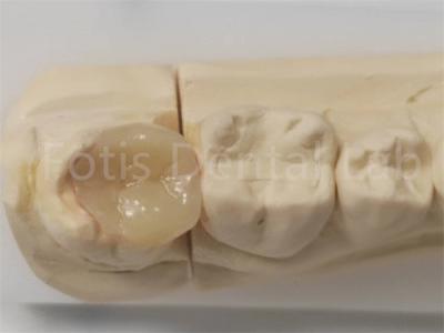 Aesthetic Inlay And Onlay In Dentistry For Indirect Filling And Tooth Restoration