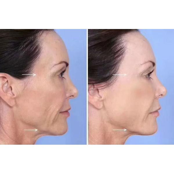 Напечатайте Botulinum BTX Hyamely  токсина Hyaluronic кисловочный дермальный заполнитель