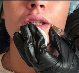 Gel médico 2ml, llenador cutáneo de Hyaluronate del sodio de la seguridad de la ha de la inyección de la cara