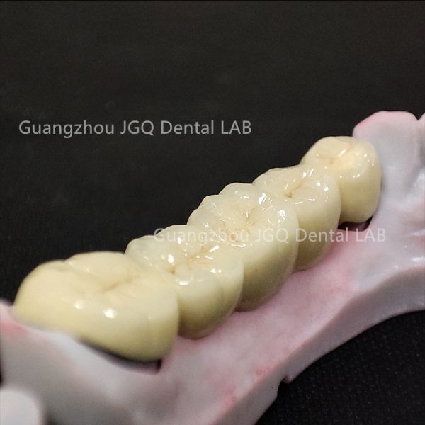 Co Cr Dental Pfm Crowns and Bridges Fixed Denture Restorations China Dental Lab
