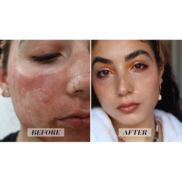 Serrage de la machine partielle de beauté de laser de CO2 de peau pour le retrait de cicatrice de colorant d'acné