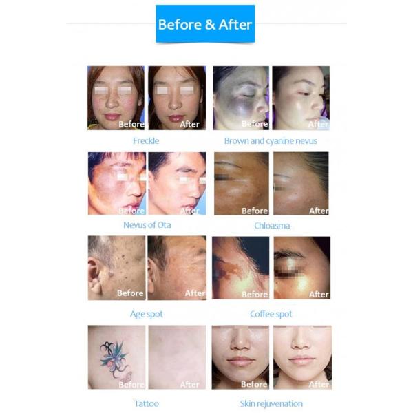 Подмолаживание кожи машины 10600nm лазера СО2 удаления пигмента частичное