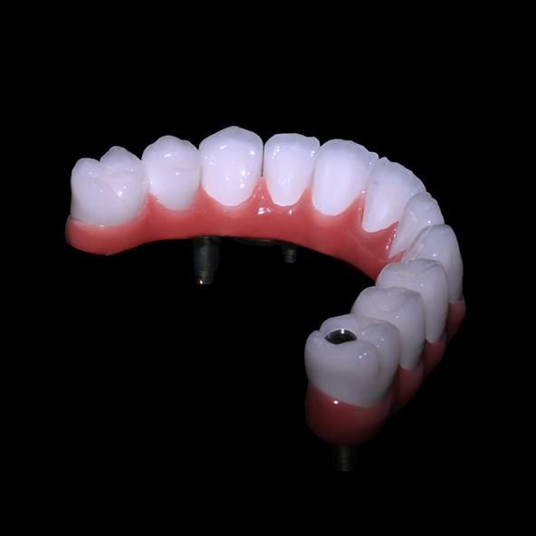 Digital Dental Solutions Lab | AOX Class I All On 4 Dental Implants Hybrid Titanium Screw Retained PFM