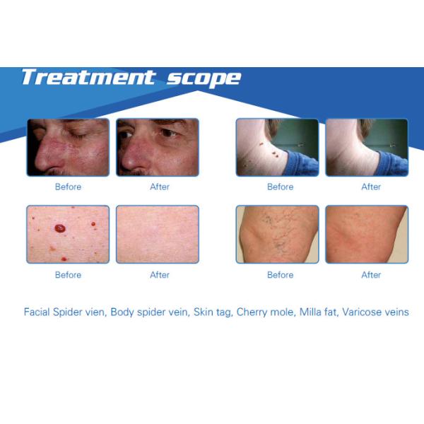 2017 latest 980nm diode laser spider vein/ skin tag removal machine
