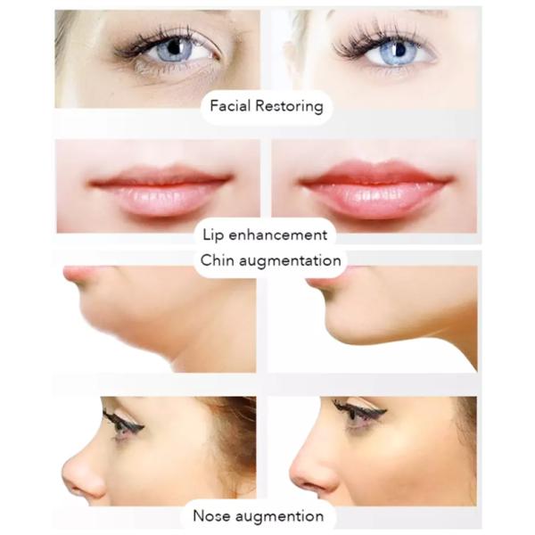 Revolax Injectable HA Dermal Filler Hyaluronic Acid Lip Enhancement
