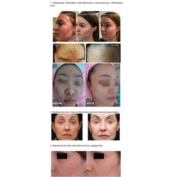 Vertical Plasma Skin Regeneration For Acne and Acne Scar Treatment with Plasma Plason Sono Ultrasonic DDS Toning Skin Rejuvenation