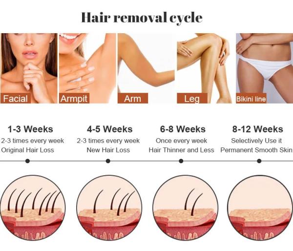 Professional Diode Laser Hair Removal Device - Smooth And Perfect Care For Your Skin