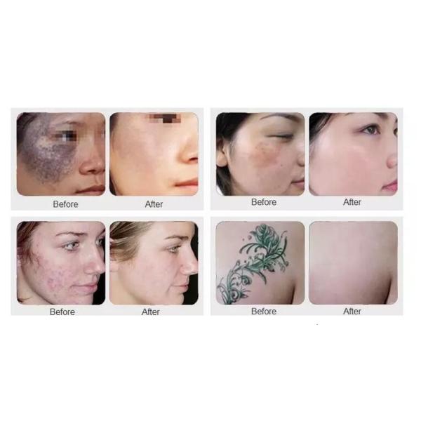IPL SHR ND Yag Laser Machine Effective For Unwanted Hair / Tattoo Removal
