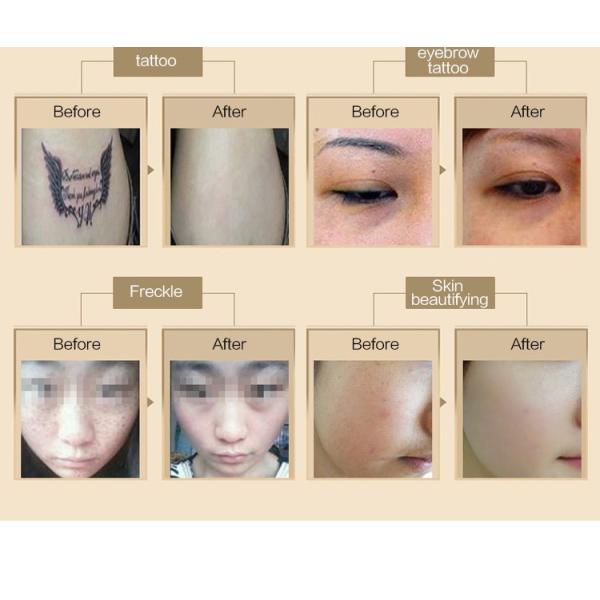 C8 Nd yag laser for freckles pigment age spots removal beauty machine