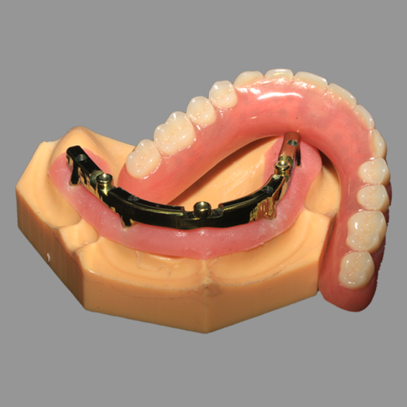 Lmplant Dental Laboratory | Full Acrylic Denture All On X Dental Lmplants AOX Class 4 With Locator Attachment