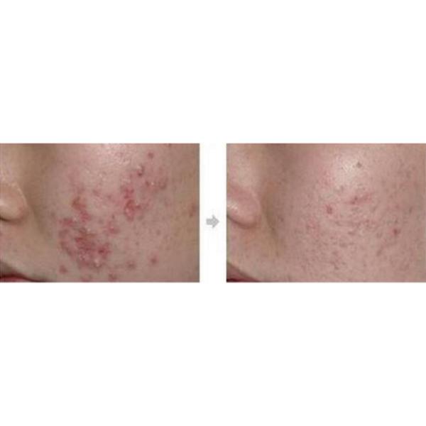 Сыворотка и вода скруббера кожи ультразвука слезая гидро facial кожи с Hydradermabrasion