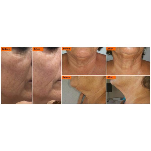 Advanced 3D Hifu Face Lifting Machine 0.2 - 3.0J Energy Short Treatment Time