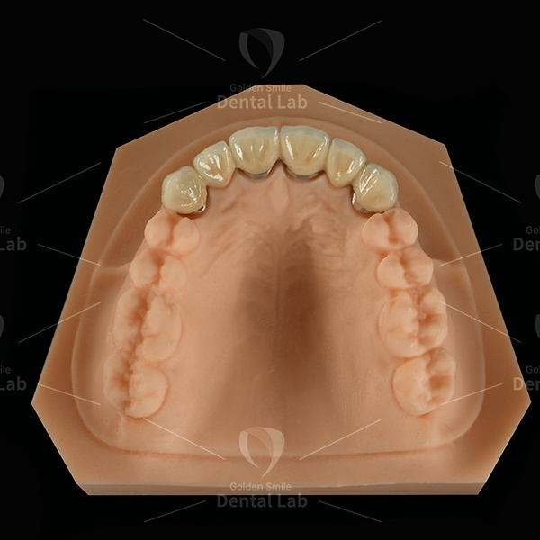 Co-Cr PFM Bridge Cobalt Chrome Alloy Dental Bridge Full Crown Restoration