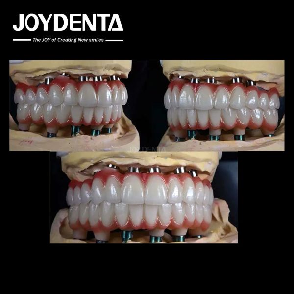 10mm Titanium Multiple Teeth Implant Rough Surface For Dental Restoration