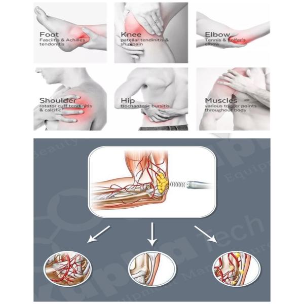 Extracorporeal Air Pressure Therapy Machine Acoustic Wave Type For Sports Injury Recovery