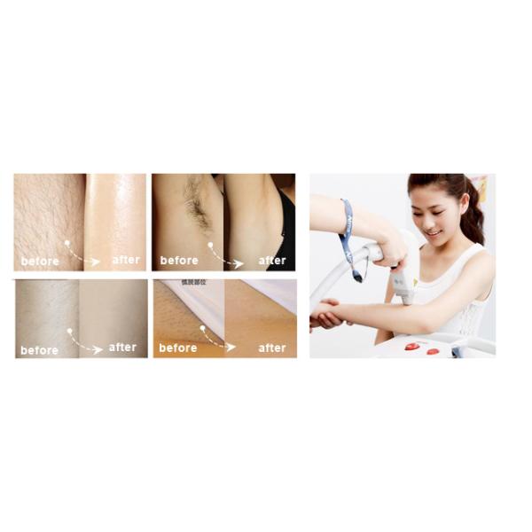 Professional Electrical Hair Removal Devices Alexandrite Wavelength 425mm×465mm×1100mm