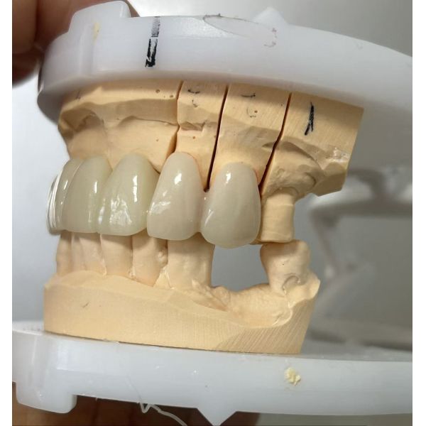 Full Zirconia dental bridge for high strength and durable dental restoration