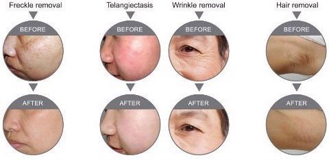 Laser IPL Hair Removal Machines For skin tightening and vascular removal