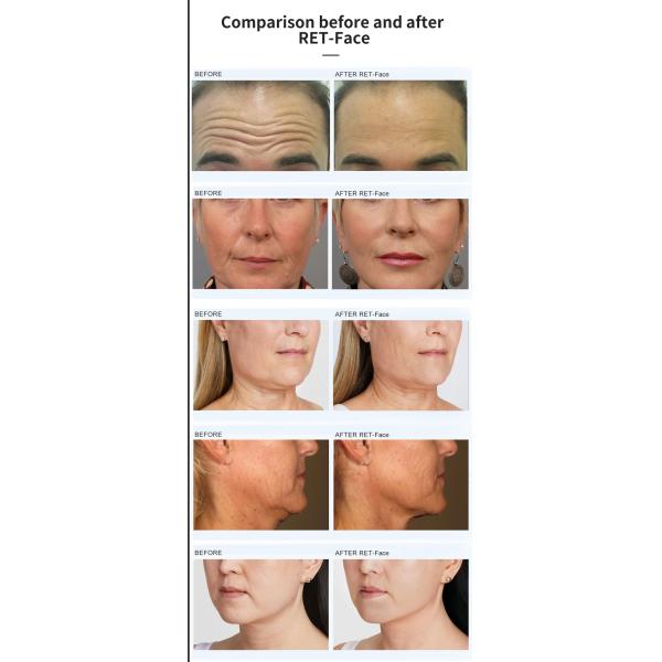 Вертикальный магнитный лицевой Ems rf Омолаживание кожи Лифтинг кожи Утягивание похудения Rf Лифтинг Машина для макияжа