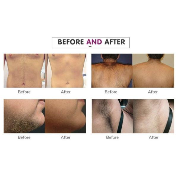 800w Vertical Elight Laser Hair Removal Beauty Salon Equipment