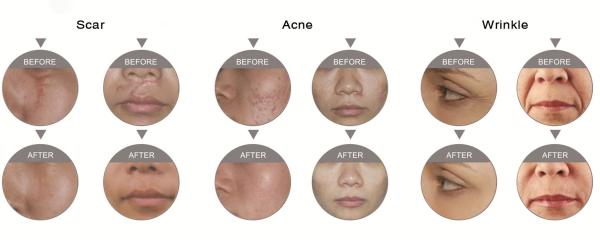 Acne Scar Laser Beauty Machine Air Cooling Permanent Hair Removal