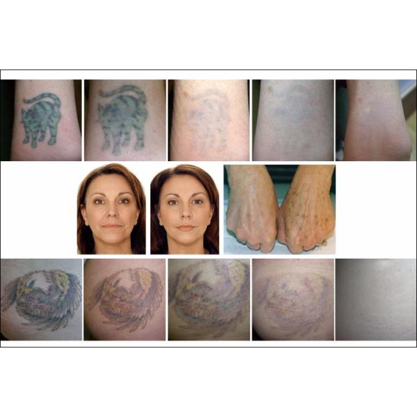 прибор машины 1064nm Microdermabrasion удаления татуировки лазера 755nm 532nm picolaser