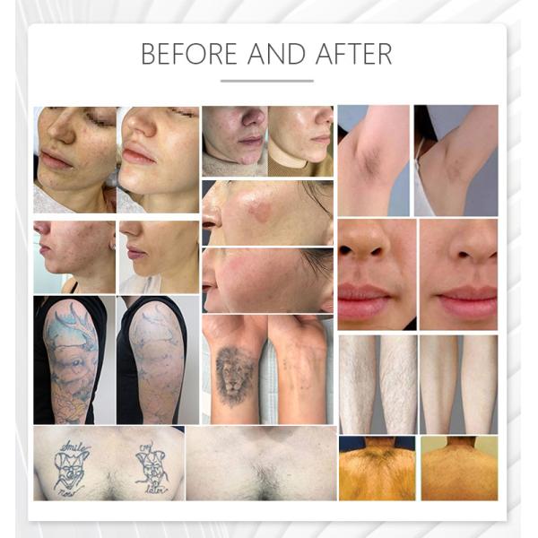 Laser Hair Removal Ipl M22 E-Light Two Handles Nd Yag Laser Machine