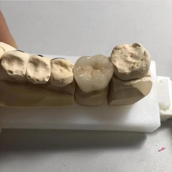 ISO FDA CE Dental Metal Post And Core Crown PFM Good Fit
