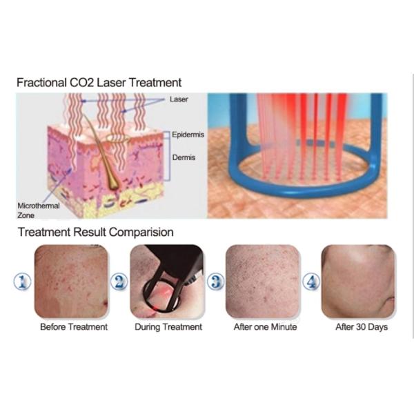 Углекислый диоксид лазерная фракционная CO2 машина для осветления и затягивания кожи